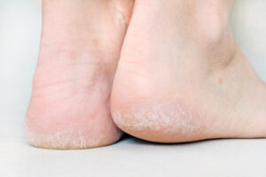 Callus Foot Treatment